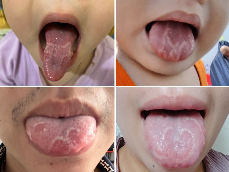 Nấm lưỡi bản đồ nhẹ